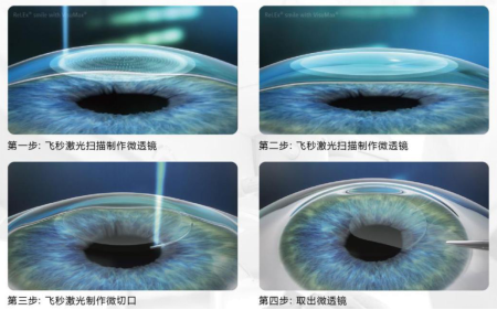 屈光矯視,希瑪瑞視眼科,上海眼科醫院