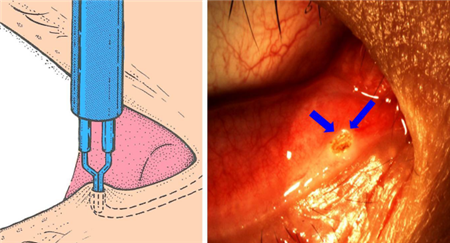 眼表眼角膜,希瑪瑞視眼科,上海眼科醫院