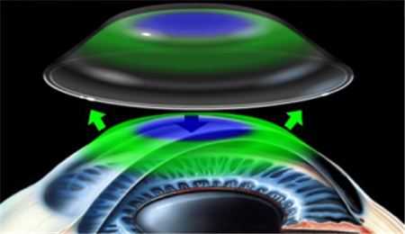 玻璃體視網膜,希瑪瑞視眼科,上海眼科醫院 玻璃體視網膜,希瑪瑞視眼科,上海眼科醫院