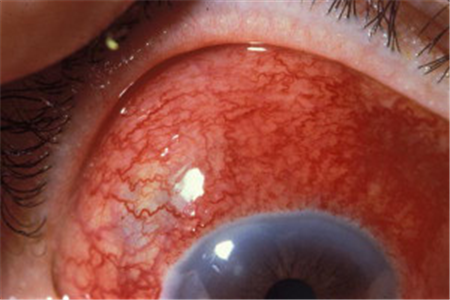 眼表眼角膜,希瑪瑞視眼科,上海眼科醫院