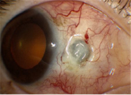 眼表眼角膜,希瑪瑞視眼科,上海眼科醫院