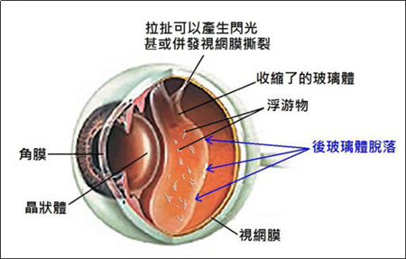 玻璃體視網膜,希瑪瑞視眼科,上海眼科醫院