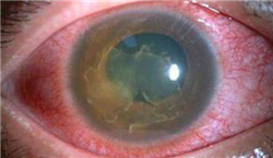 眼表眼角膜,希瑪瑞視眼科,上海眼科醫院