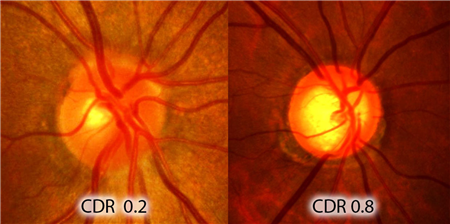 眼表眼角膜,希瑪瑞視眼科,上海眼科醫(yī)院 眼表眼角膜,希瑪瑞視眼科,上海眼科醫(yī)院