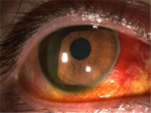 玻璃體視網膜,希瑪瑞視眼科,上海眼科醫院