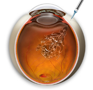 玻璃體視網膜,希瑪瑞視眼科,上海眼科醫院