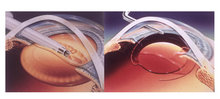 眼表眼角膜,希瑪瑞視眼科,上海眼科醫院