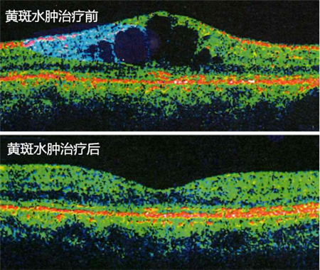 玻璃體視網膜,?，斎鹨曆劭?上海眼科醫院