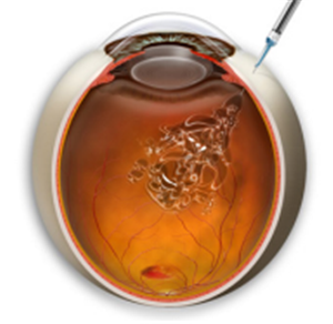 玻璃體視網(wǎng)膜,希瑪瑞視眼科,上海眼科醫(yī)院