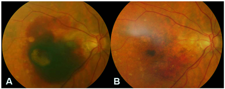 玻璃體視網(wǎng)膜,希瑪瑞視眼科,上海眼科醫(yī)院