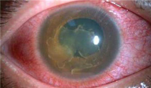 眼表眼角膜,希瑪瑞視眼科,上海眼科醫院