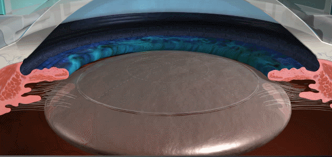 白內障,希瑪瑞視眼科,上海眼科醫院 白內障,希瑪瑞視眼科,上海眼科醫院