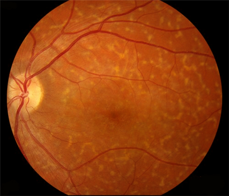 玻璃體視網膜,希瑪瑞視眼科,上海眼科醫院 玻璃體視網膜,希瑪瑞視眼科,上海眼科醫院