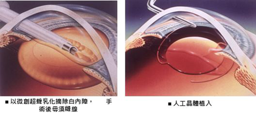 屈光矯視,希瑪瑞視眼科,上海眼科醫院