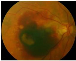 玻璃體視網(wǎng)膜,?，斎鹨曆劭?上海眼科醫(yī)院