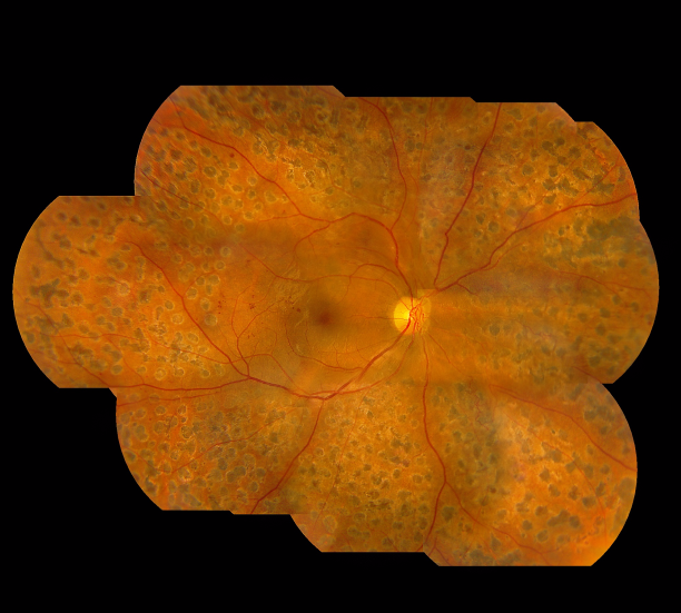 玻璃體視網膜,希瑪瑞視眼科,上海眼科醫院