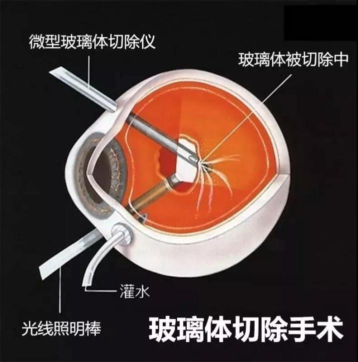 玻璃體視網(wǎng)膜,希瑪瑞視眼科,上海眼科醫(yī)院 玻璃體視網(wǎng)膜,希瑪瑞視眼科,上海眼科醫(yī)院