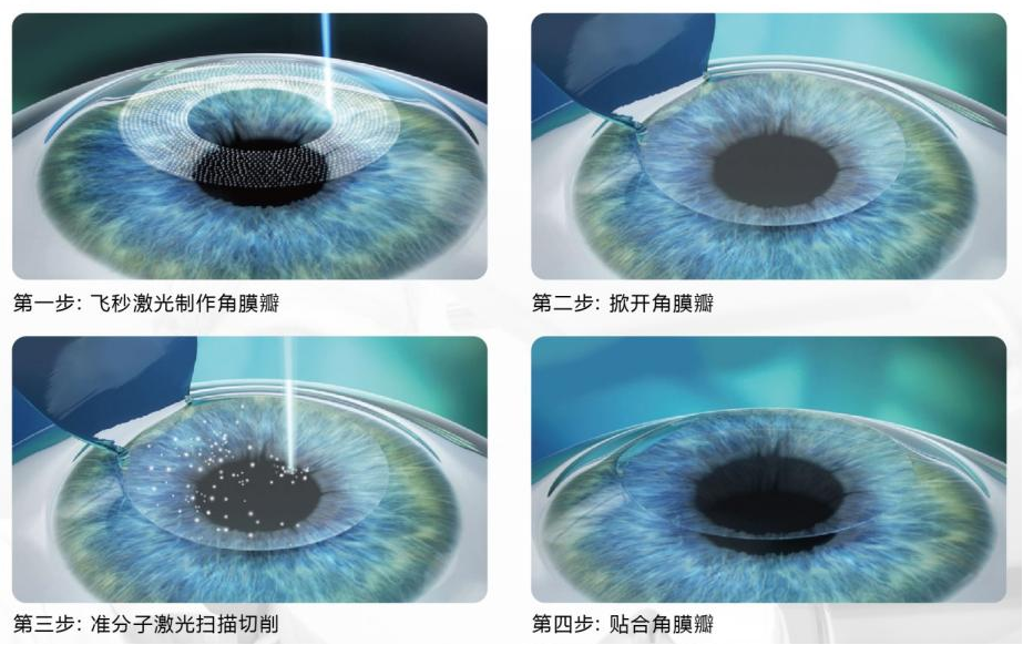 屈光矯視,希瑪瑞視眼科,上海眼科醫院 屈光矯視,希瑪瑞視眼科,上海眼科醫院