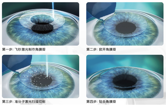 屈光矯視,希瑪瑞視眼科,上海眼科醫(yī)院