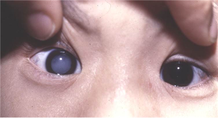 白內(nèi)障,希瑪瑞視眼科,上海眼科醫(yī)院 白內(nèi)障,希瑪瑞視眼科,上海眼科醫(yī)院