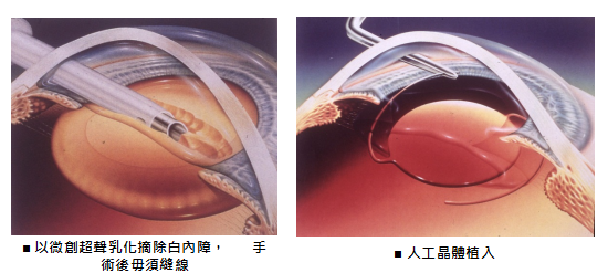 白內障,希瑪瑞視眼科,上海眼科醫(yī)院